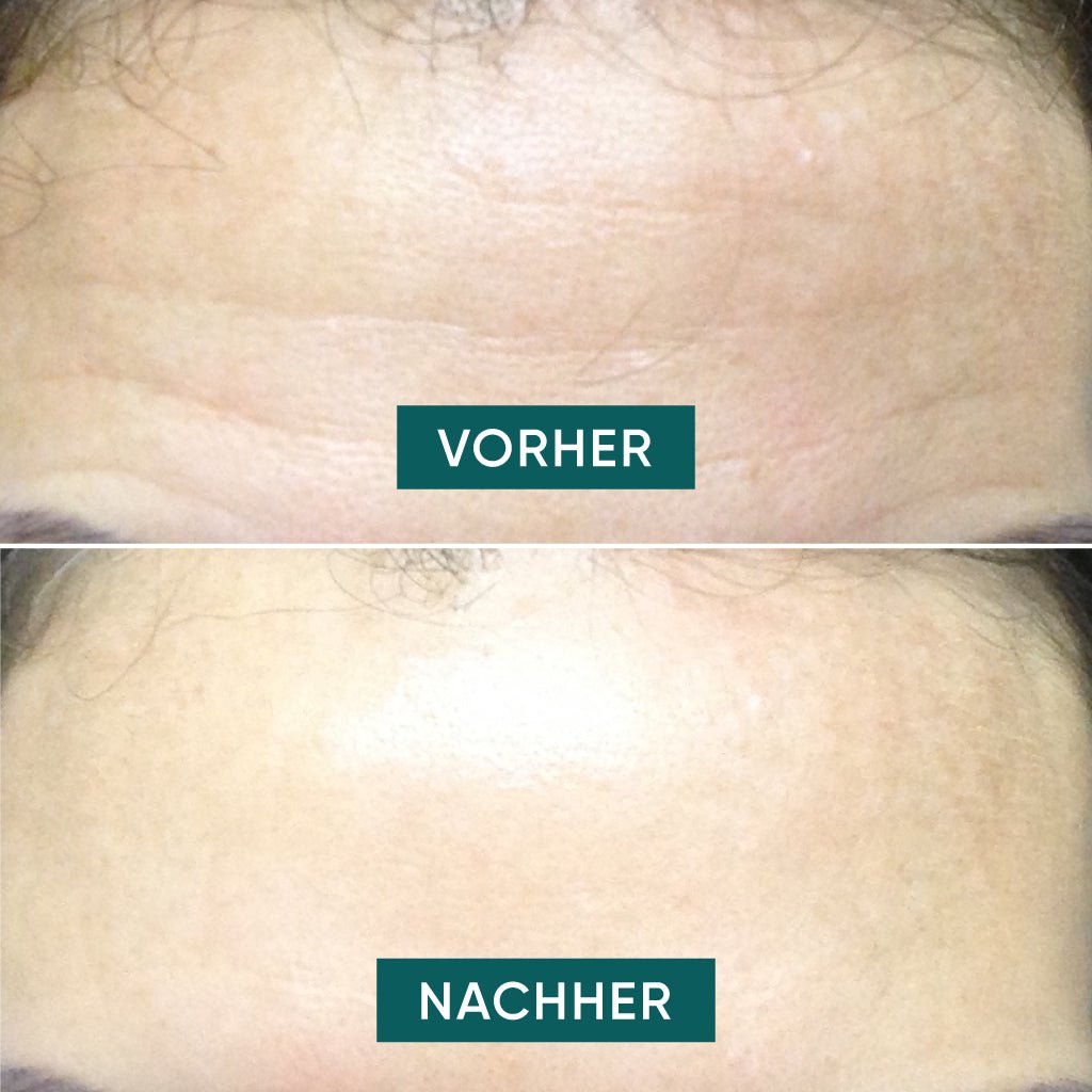 Apricot voorhoofd pad met hyaluron herbruikbaar